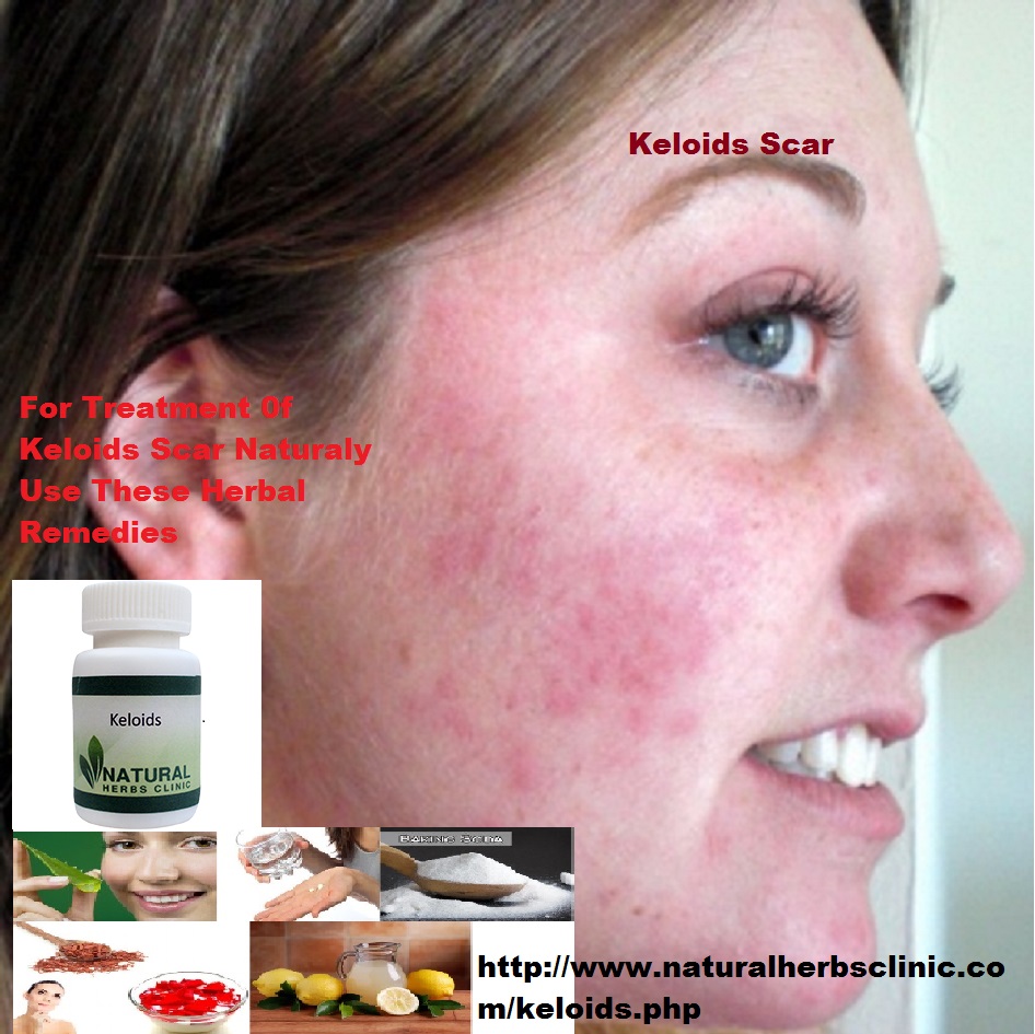 Keloids Herbal Remedies